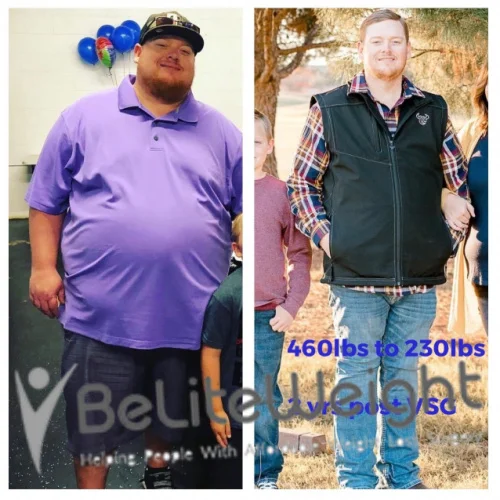 Weight Loss Surgery Gastric Sleeve before and after